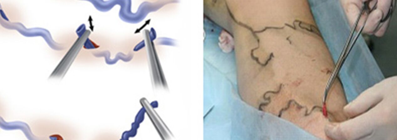 Traitement chirurgical des veines.