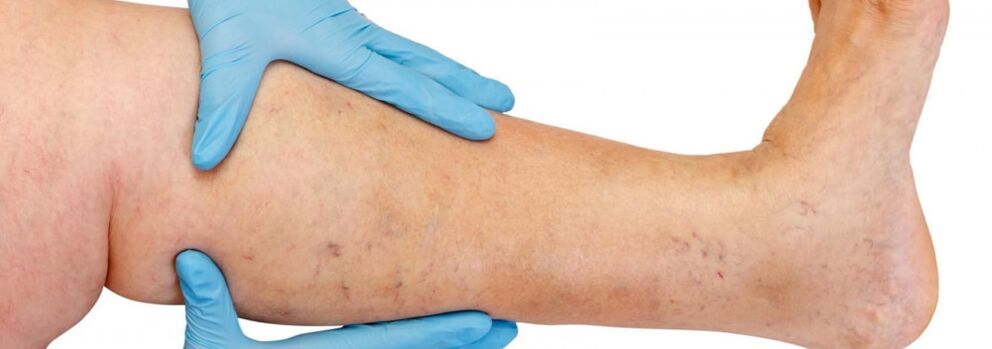Varices dans la jambe.