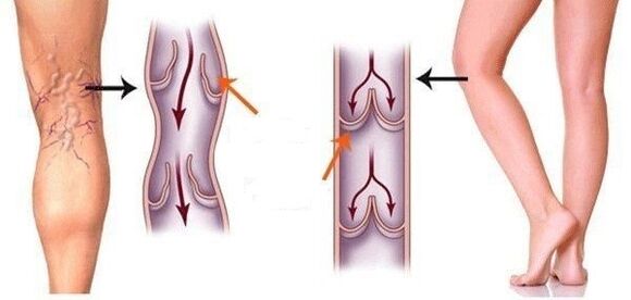 veines saines et varices