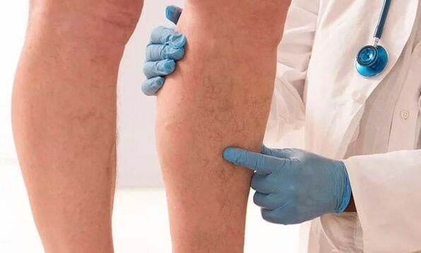 Le médecin examine les jambes à la recherche de varices.